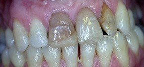  - Una giovane paziente con sorriso gravemente alterato dalla evidente discromia degli incisivi superiori