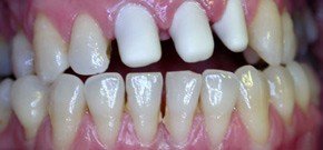  - Prova intermedia delle cappette in zirconio, perfettamente coprente la colorazione scura sottostante