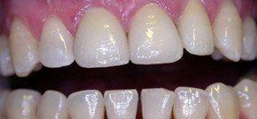  - Caso finito con posizionamento di tre corone in zirconio e rifacimento di una otturazione estetica