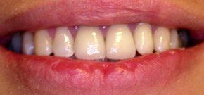  - La paziente può finalmente sorridere senza imbarazzo