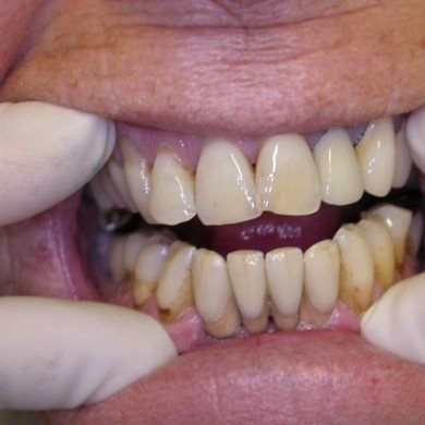  - Protesizzazione con quattro elementi dentali fissi su due impianti