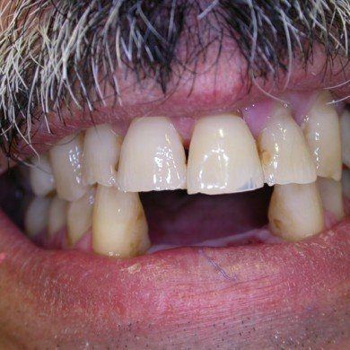  - Situazione originale: mancanza degli incisivi inferiori