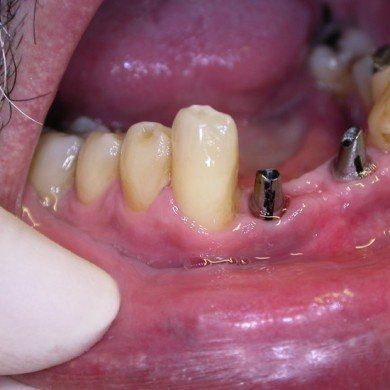  - Applicazione di due impianti (i denti contigui non vengono coinvolti)